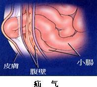 疝气的形成原因